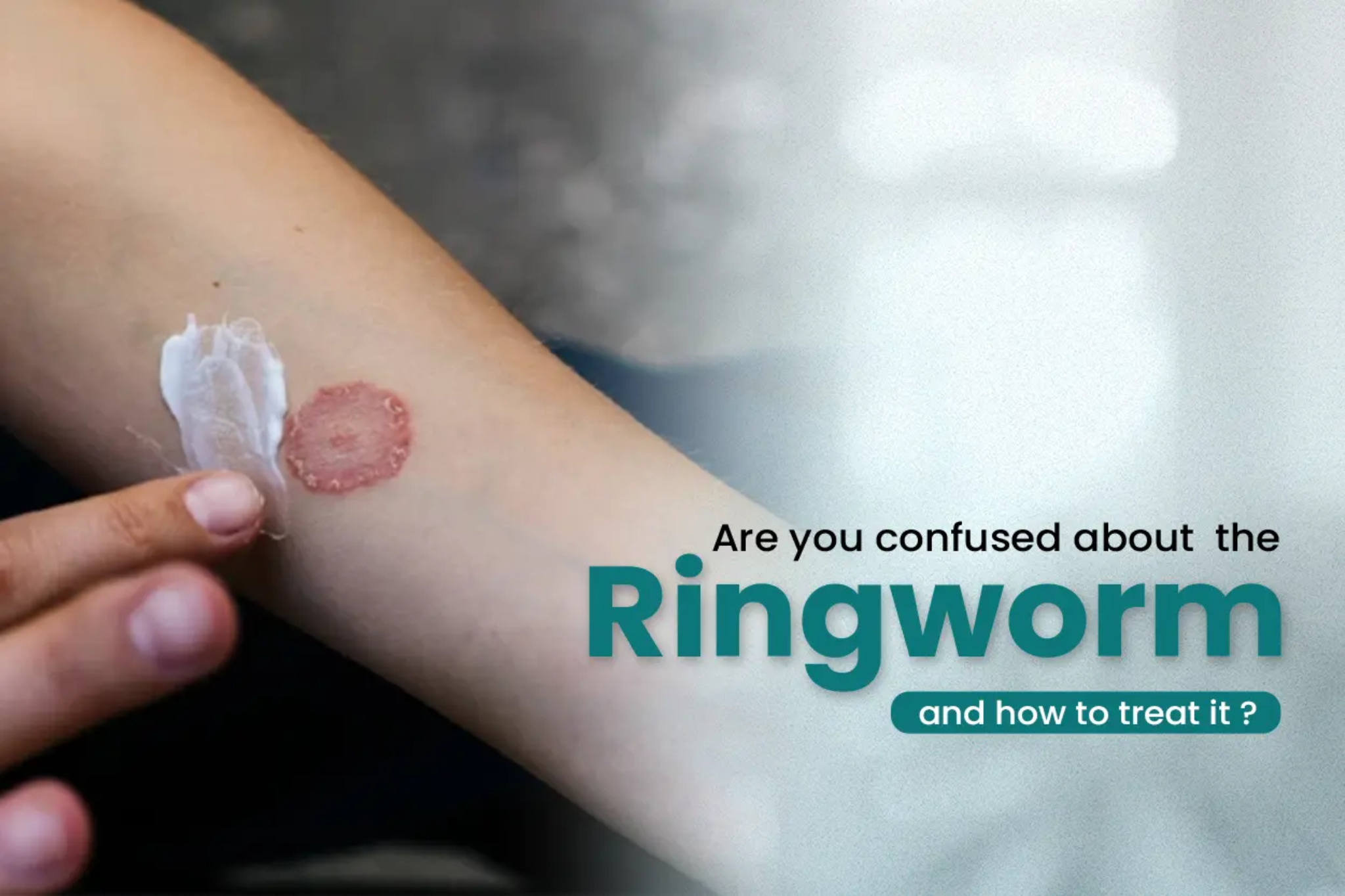 How to Treat Ringworm at Home: Dermatologist-Approved Tips for Quick Relief